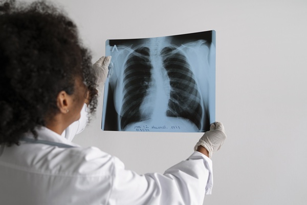 Modelo de IA identifica novos preditores de tuberculose ativa em pessoas vivendo com HIV, conta Medscape